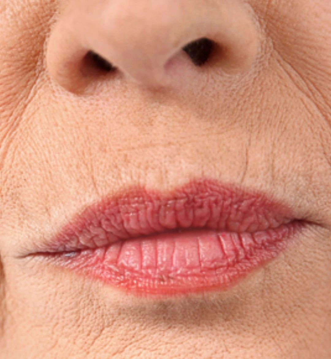 Get Rid of Vertical Lines above the Mouth